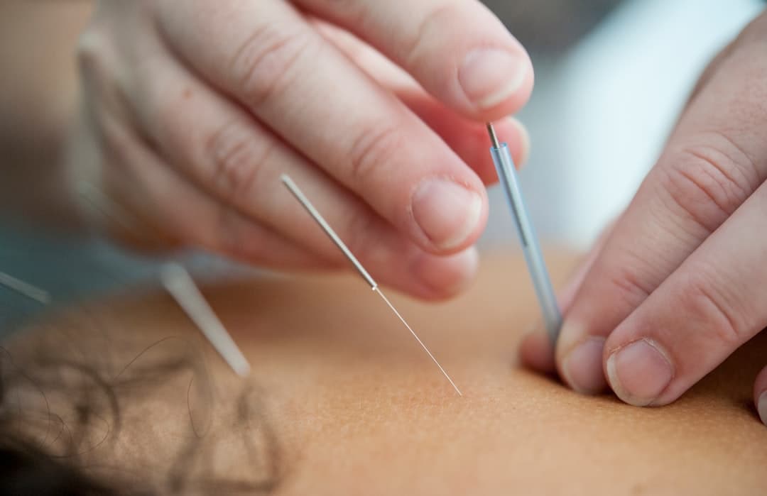 Acupuncture for Menopause in Great Neck, NY: Natural Relief for Hot Flashes and Sleep