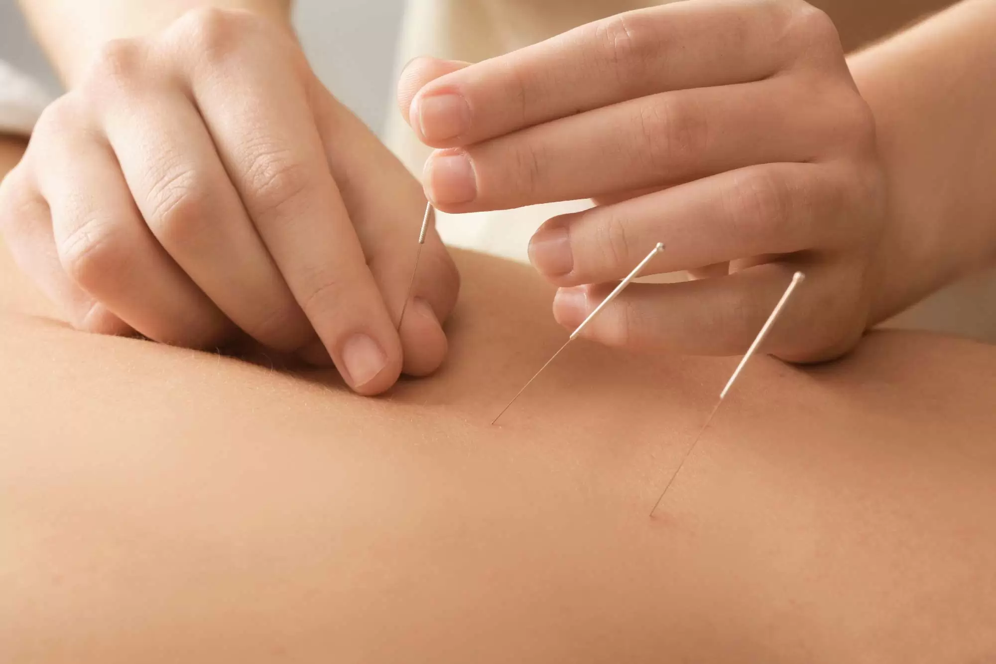 Acupuncture